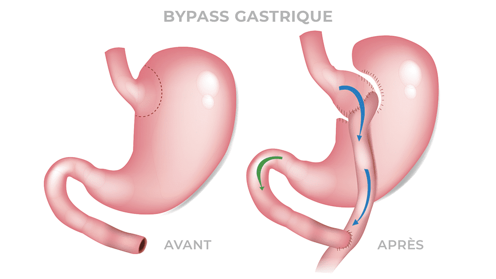 Bypass gastrique au Maroc