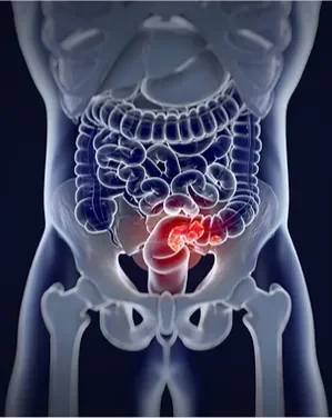 Faites confiance au Dr. Kohen Mohamed, expert en chirurgie cancérologique digestive à Casablanca.