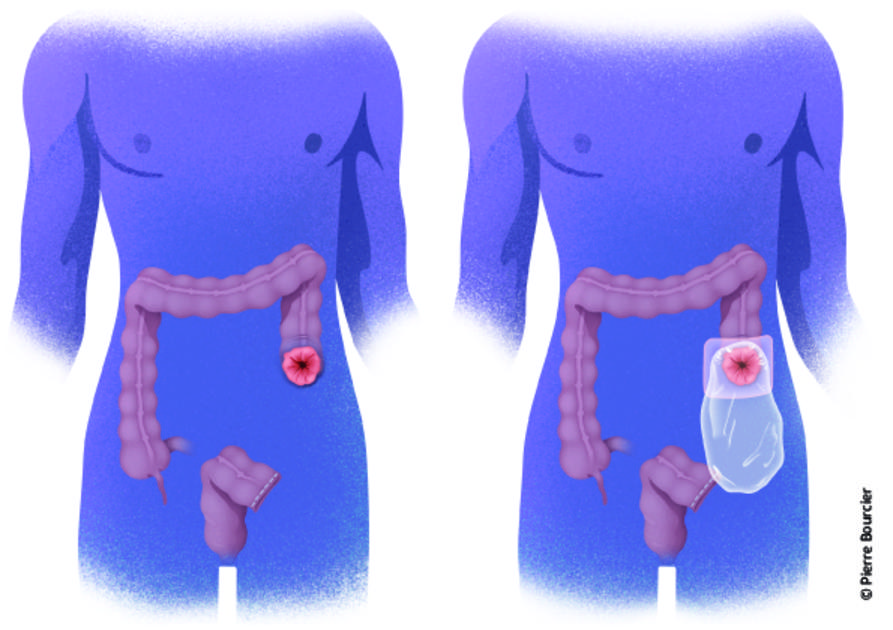 Chirurgie du Cancer Digestif – Un Traitement Spécialisé avec le Dr. Kohen Mohamed