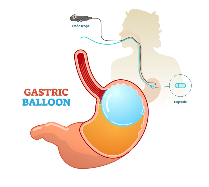 Ballon Gastrique : Une Alternative Non Chirurgicale pour Perdre du Poids