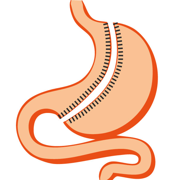 Sleeve Gastrectomie au Maroc – Une Chirurgie Bariatrique Révolutionnaire